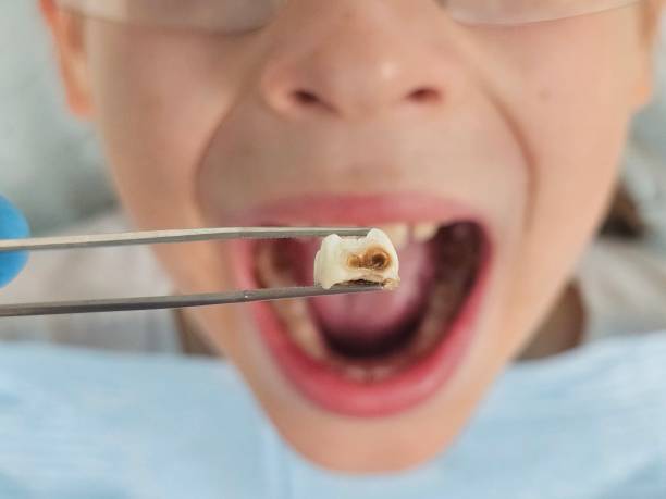 Best Emergency Gum Treatment in Cedar Falls, IA
